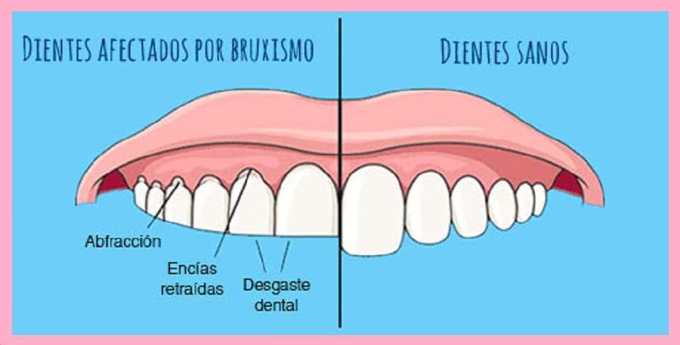 clinica dental Romeo - 💚 Como sabes la férula de descarga es un  dispositivo muy utilizado para las personas que aprietan o rechinan los  dientes,😬 y también las que padecen bruxismo. 🤨