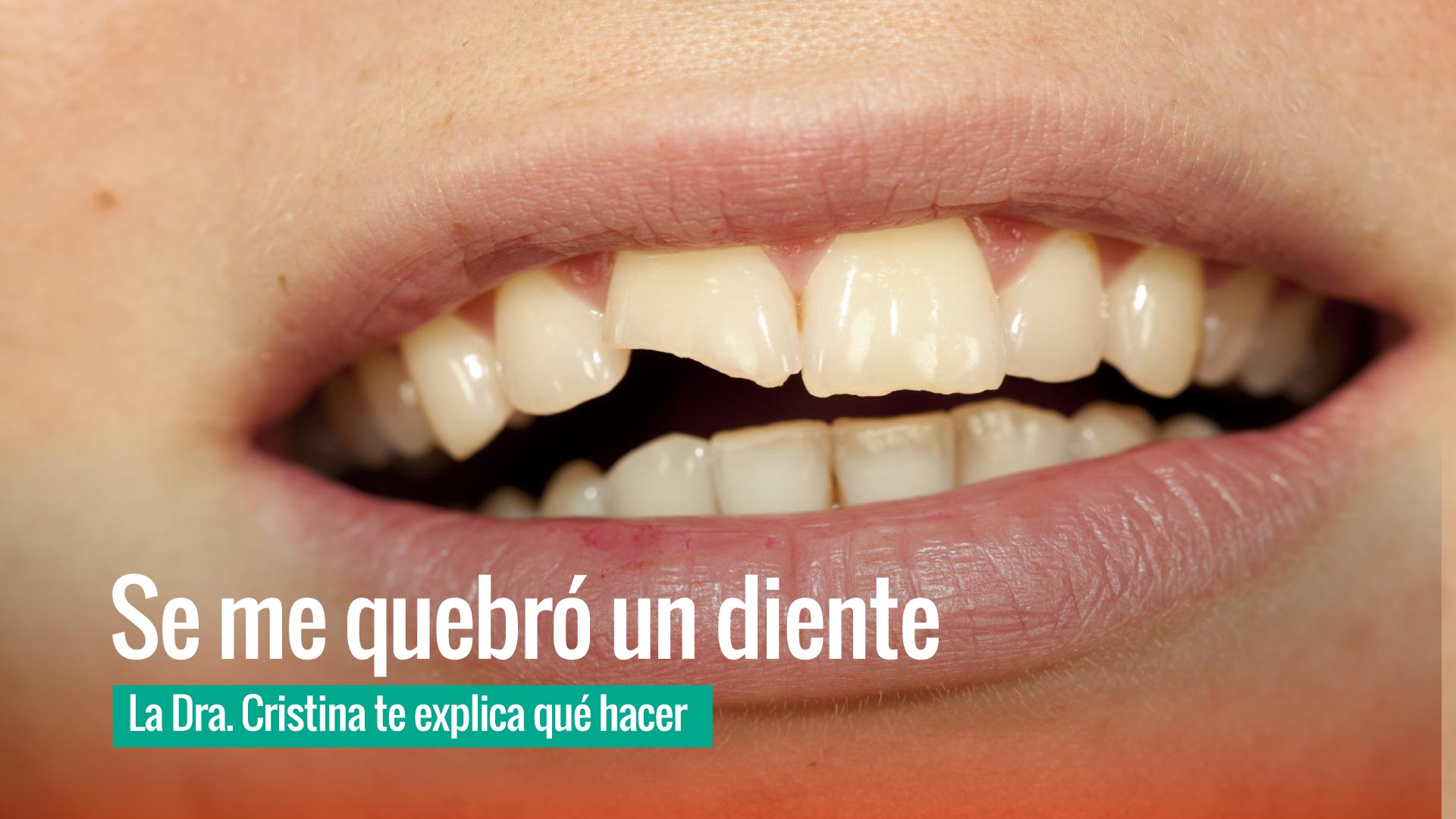 ¿Qué hacer si se rompe un diente? | Dra. Cristina López